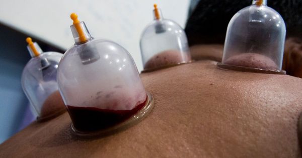 Everything Fit Guys Need to Know About Wet Cupping