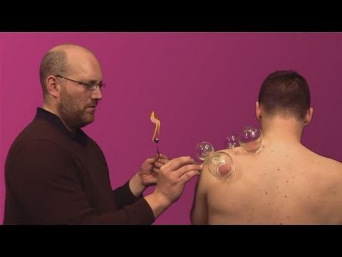 Fire Cupping How To