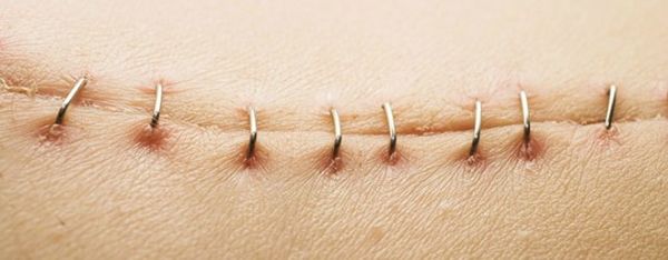 Signs You May Need Stitches for That Cut