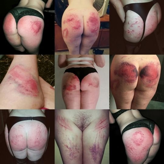 Bruises in Impact play.