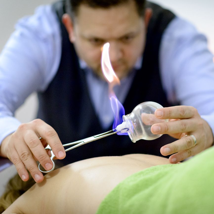 Cupping