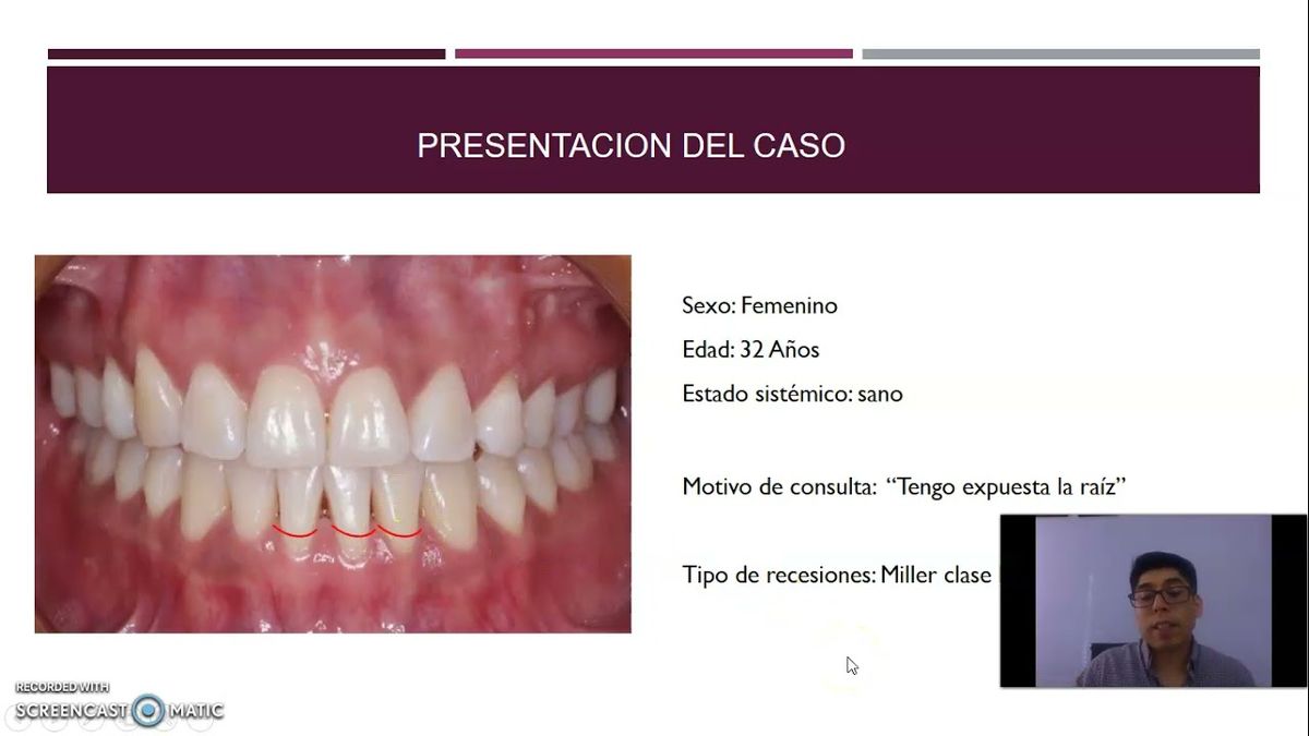 HID213 - Recubrimiento de Recesiones Gingivales y Modificación del Fenotipo Periodontal con Injert…