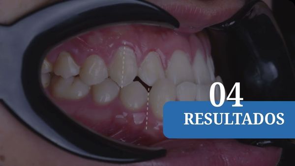 INT038- Maloclusión en la Salud Oral: Análisis de las Consecuencias Funcionales y Estéticas # In…