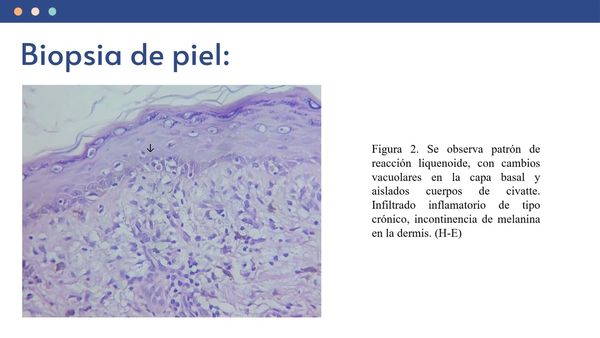 CEL582 - Reporte de Caso: Liquen Plano Pigmentado