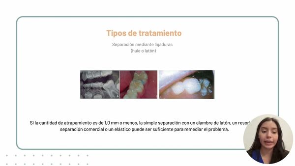 CDX114 - Erupcion ectopica del primer molar permanente superior