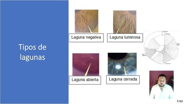 ZTP128 - Análisis de Imágenes de Iris Ocular de Personas Diabéticas y no Diabéticas