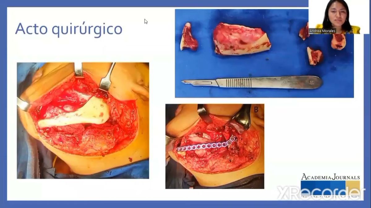 PBL076 - Fibromixoma odontogénico: Reporte de un Caso y Revisión de la Literatura