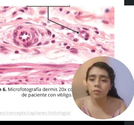 PUE058 - Cambios De La Microvasculatura En Lesiones De Vitiligo