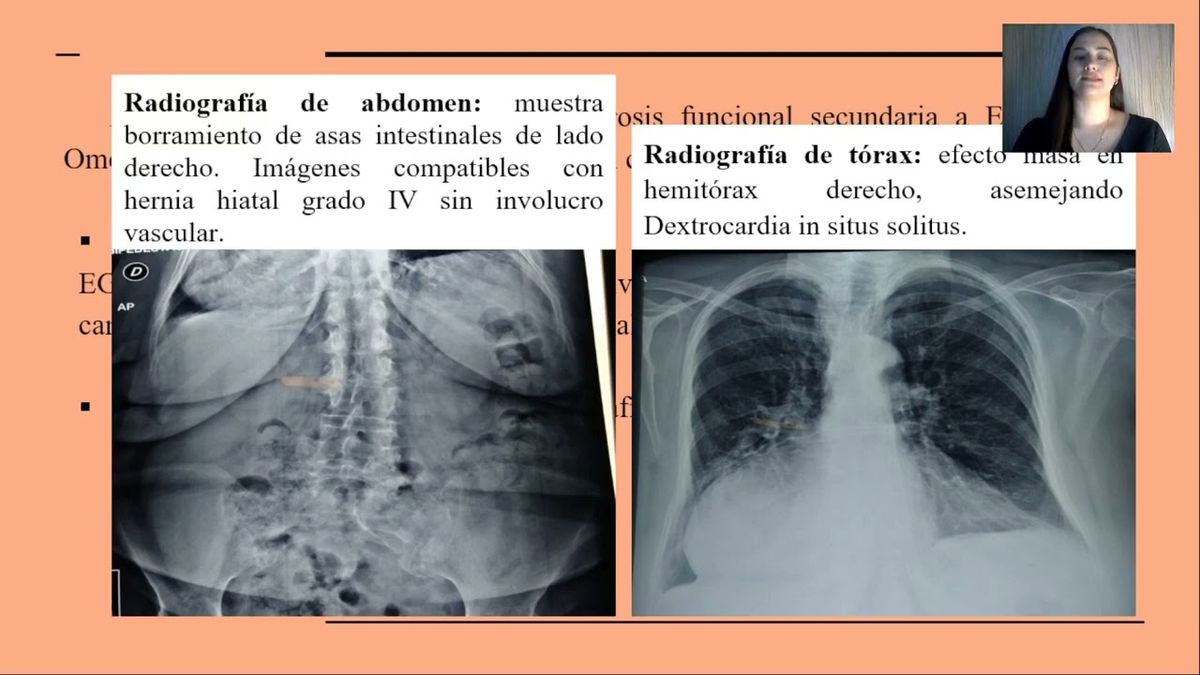 HLG310 - Reporte de Caso: Hernia Hiatal Gigante con Estómago Intratorácico