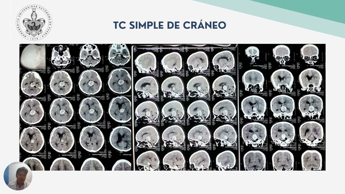 TLA042 - Aneurisma Trombosado de la Arteria Basilar: Reporte de un Caso en el Segundo Nivel de Ate…