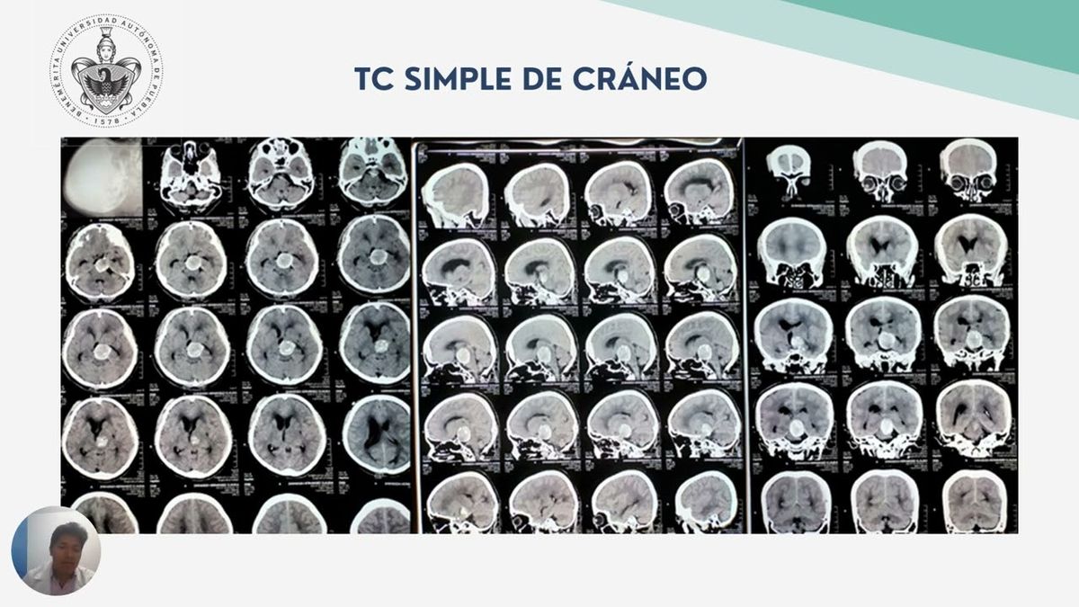 TLA042 - Aneurisma Trombosado de la Arteria Basilar: Reporte de un Caso en el Segundo Nivel de Ate…