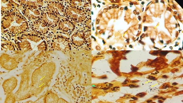 CIP132- Confiabilidad entre evaluadores del diagnóstico histopatológico de Helicobacter pylori en…
