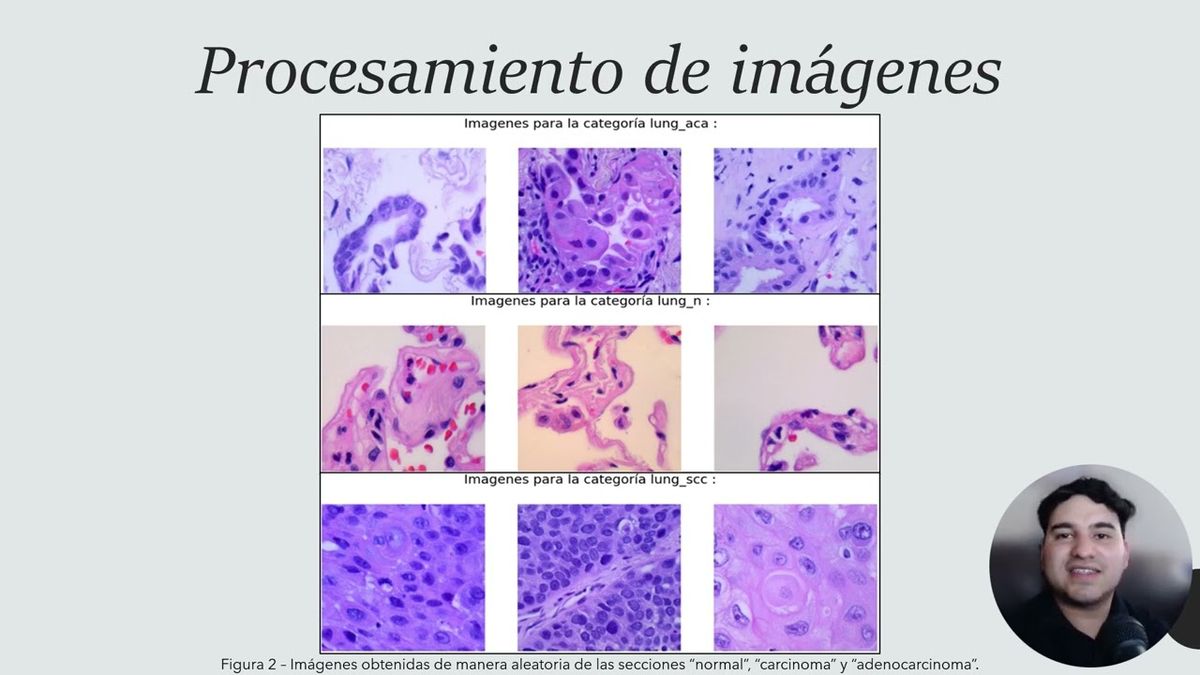 CTM167 - Detección de Cáncer de Pulmón mediante Aprendizaje por Medio de una Red Neuronal