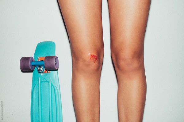 Girl in the summer with her skateboard and a scraped knee