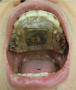 IntraOralTongueDrive_GeorgiaTech